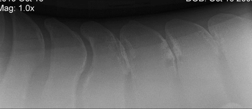 Dorsal spinous process impingement syndrome in horses